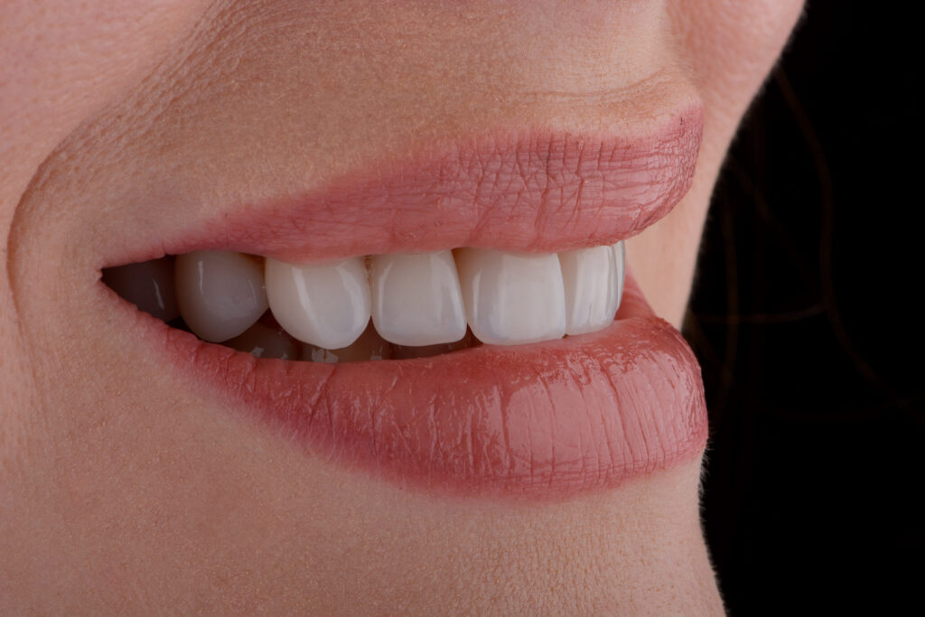 Veneers Offer A Smile Makeover Riverside Dental Group