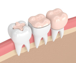 Riverside Dental Group of California is here to explain the difference between restoration options.
