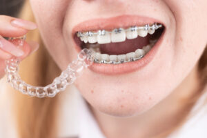 Get ahead on orthodontic care with interceptive treatments at Riverside Dental in California