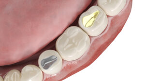 Riverside , CA , dentist offers composite resin fillings 