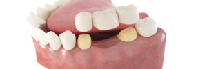 Riverside, CA, dentist offers dental bridges that can restore your smile
