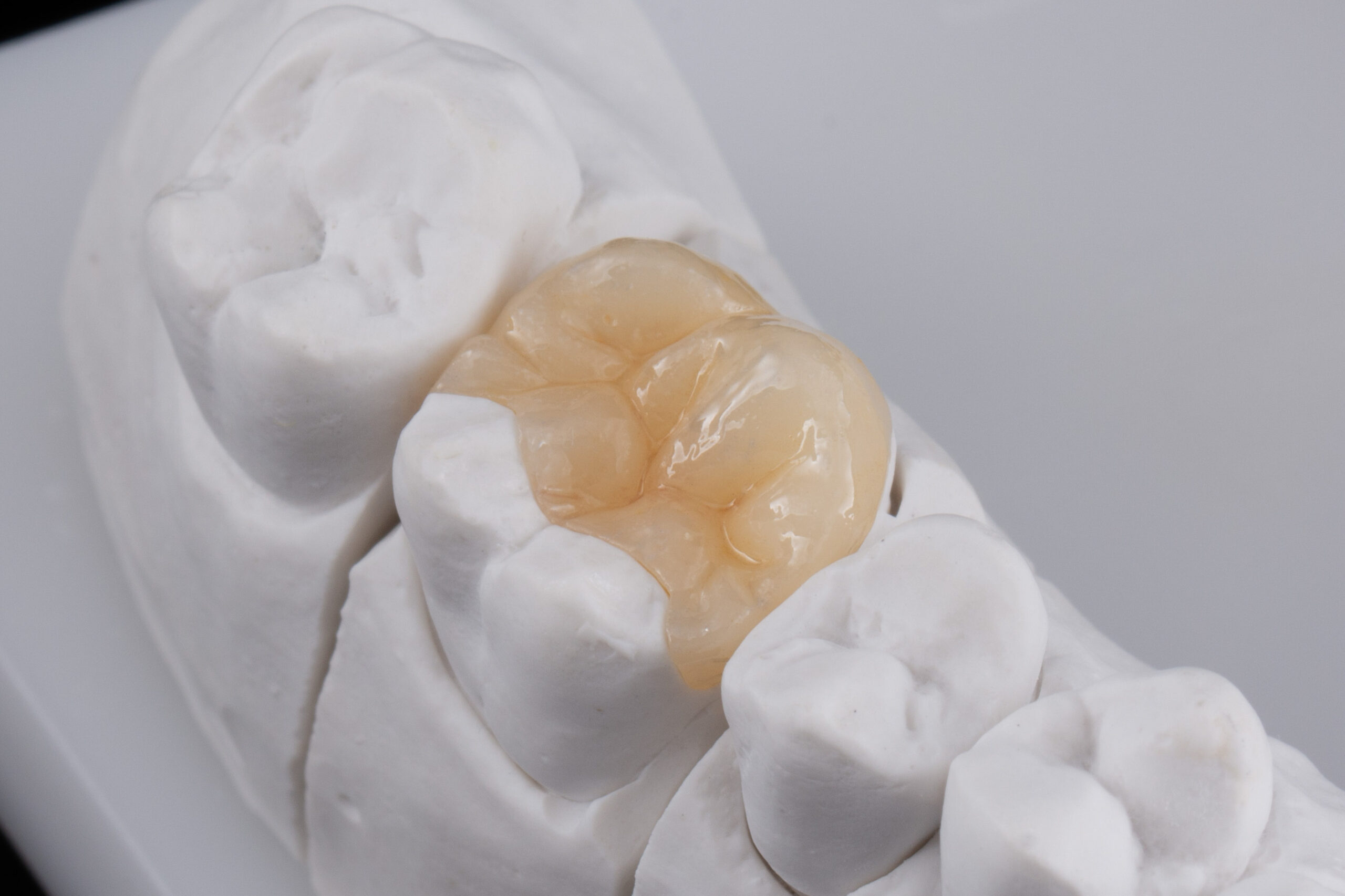 When Smiles Need Partial Crowns - Riverside Dental Group