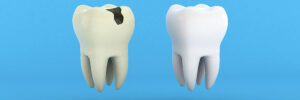 Riverside, CA, dentist offers composite resin fillings