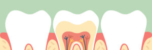 Riverside, CA, dentist offers root canals for patients