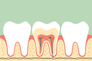 Riverside, CA, dentist offers root canals for patients 