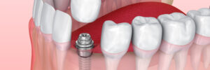 riverside dental implants
