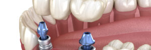 woodcrest dental implants