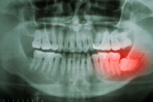 corona wisdom tooth removal