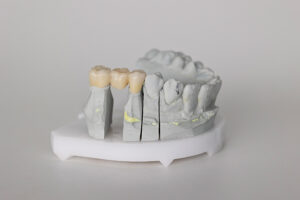 riverside dental bridges