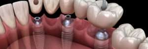 riverside dental implants