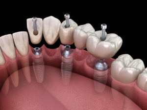 riverside dental implants