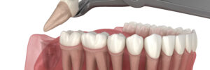 moreno valley tooth extraction