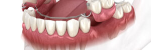 moreno valley partial denture