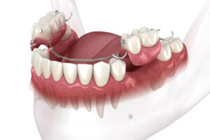 moreno valley partial denture