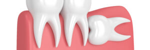 woodcrest wisdom tooth extraction