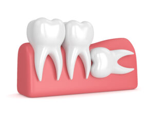 woodcrest wisdom tooth extraction