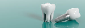 riverside dental implants