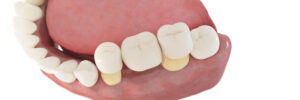 oasis dental bridge