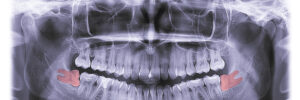 temecula wisdom teeth