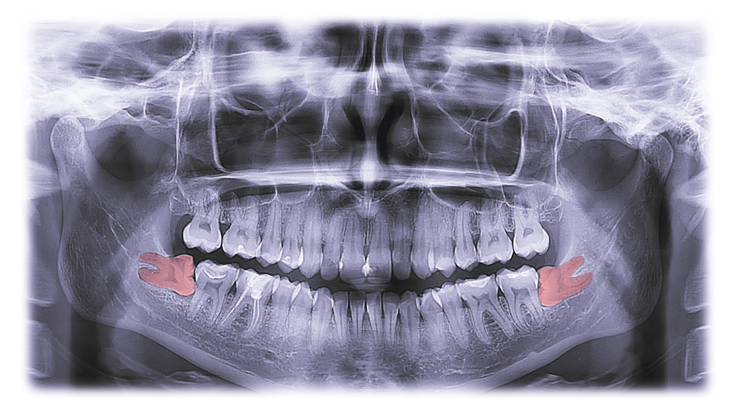 Why Do Wisdom Teeth Threaten Smiles? - Riverside Dental Group