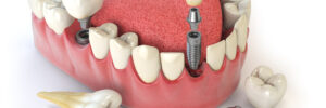 corona oral surgery