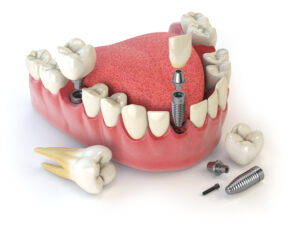 corona oral surgery