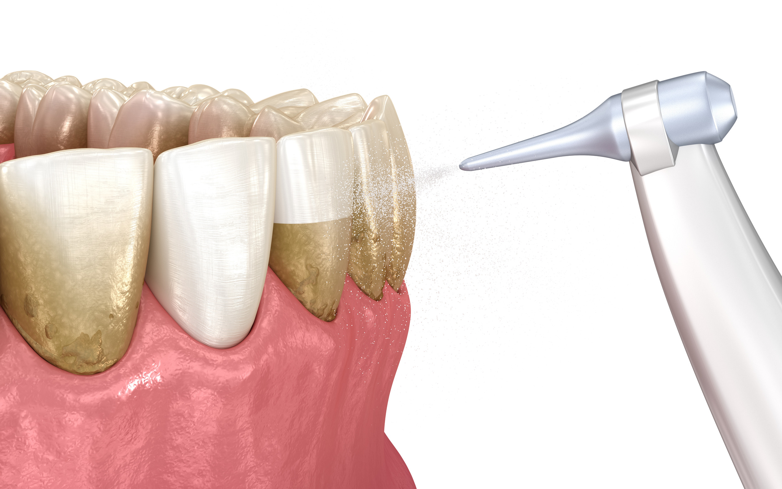 Ready For Your Smile's Spring Cleaning? - Riverside Dental Group