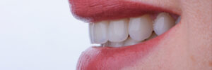 corona dental crowns
