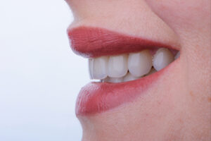 corona dental crowns