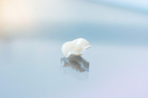 riverside inlay and onlay