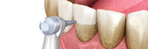 temecula periodontic therapy