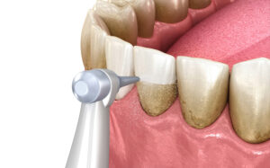 temecula periodontic therapy