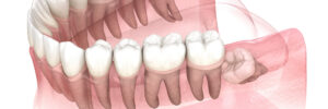 riverside wisdom teeth