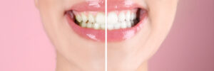 riverside teeth whitening