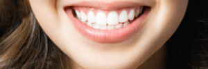 moreno valley veneers