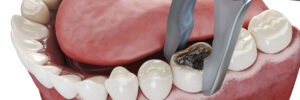 riverside tooth extraction