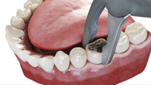 riverside tooth extraction