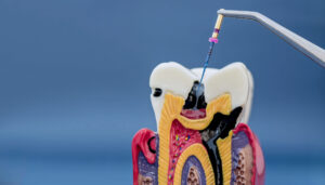 temecula endodontics