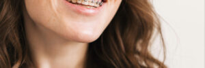 corona braces