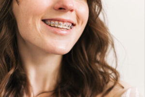 corona braces
