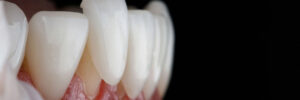 riverside veneers