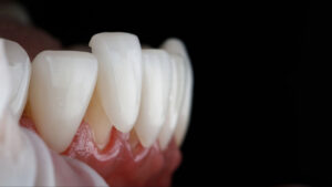 riverside veneers