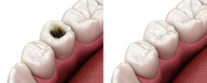 moreno valley fillings