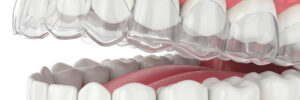 riverside invisalign