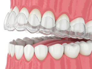 riverside invisalign