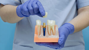 moreno valley dental implant and crown