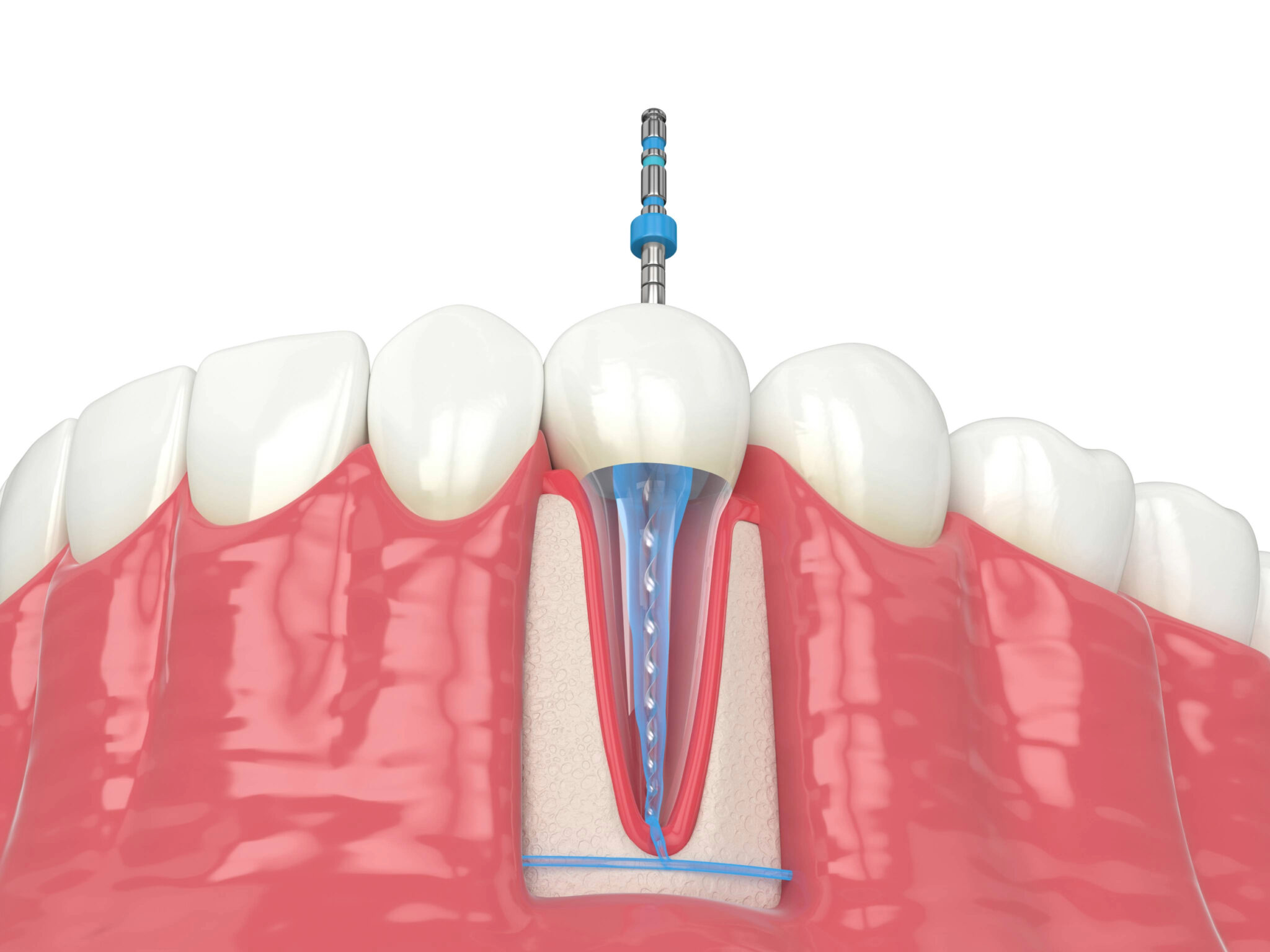 Thoot Roots Root Canal Therapy Stops Infection - Riverside Dental Group