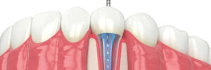 moreno valley root canal
