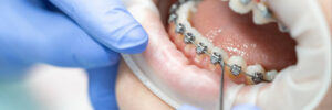 temecula braces
