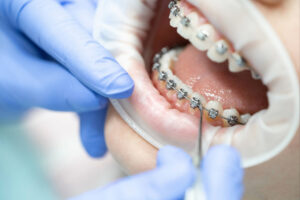 temecula braces